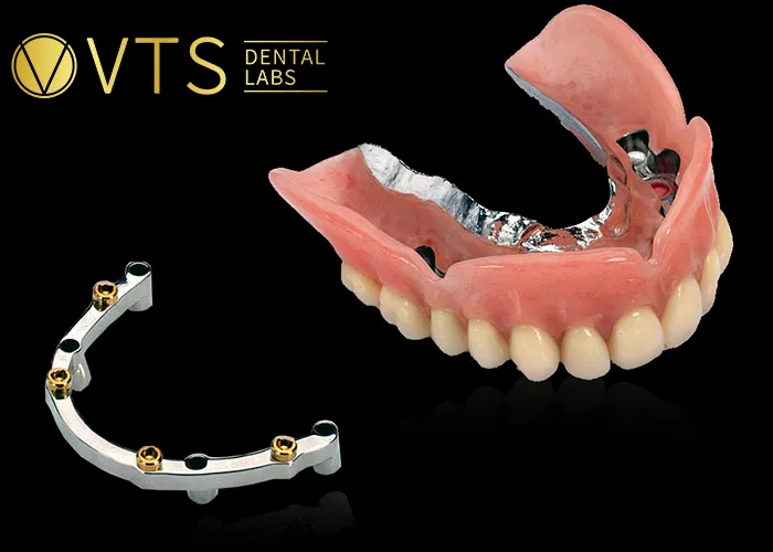 Overdentures-Expert-Tips-for-Optimal-Restoration