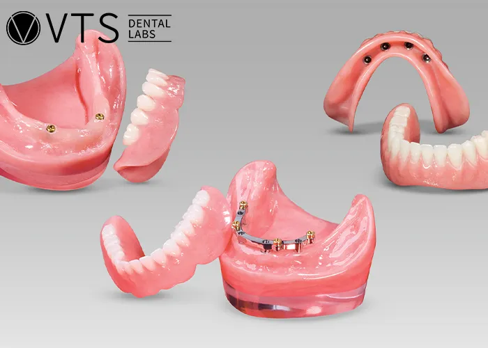 Overdentures-Expert-Tips-for-Optimal-Restoration