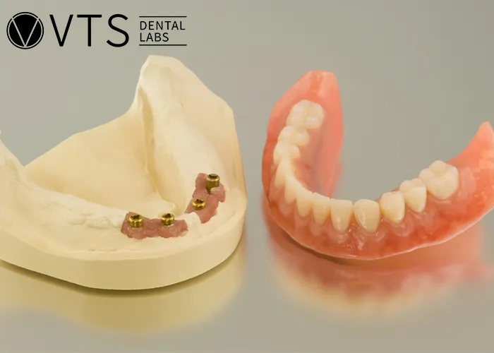 Overdentures-Expert-Tips-for-Optimal-Restoration