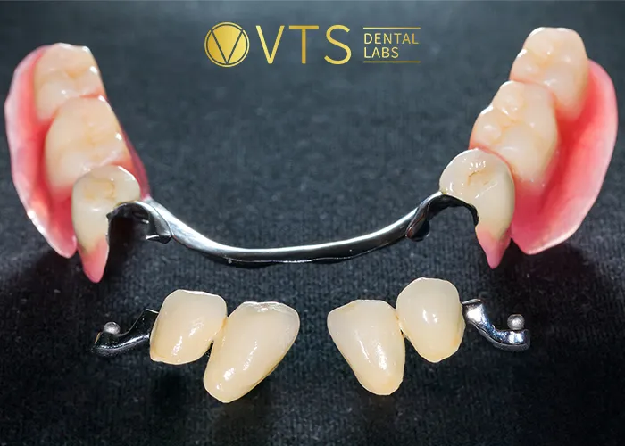 Partial-Dentures-A-Comprehensive-Solution-for-Functionality-and-Aesthetics