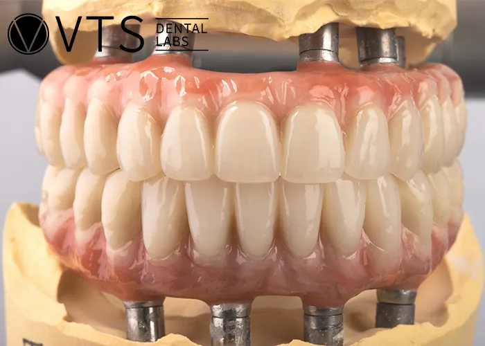 All-On-4-Dental-Implant-All-the-Essential-information-You-need