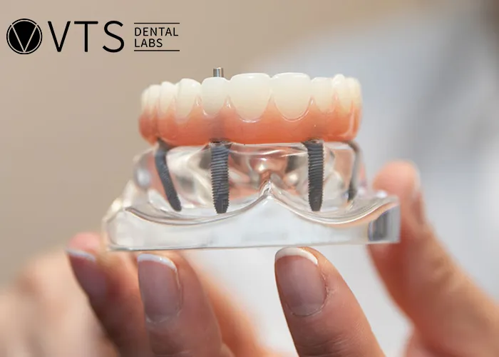 All-On-4-Dental-Implant-All-the-Essential-information-You-need