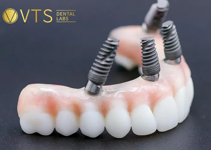 All-On-4-Dental-Implant-All-the-Essential-information-You-need