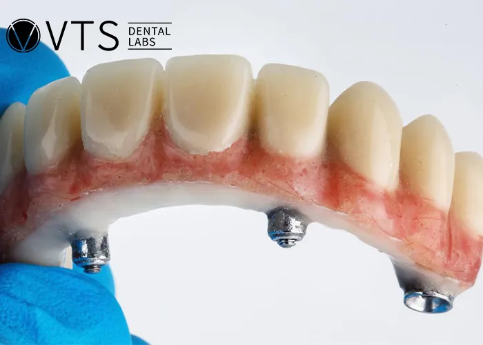 All-On-4-Dental-Implant-All-the-Essential-information-You-need