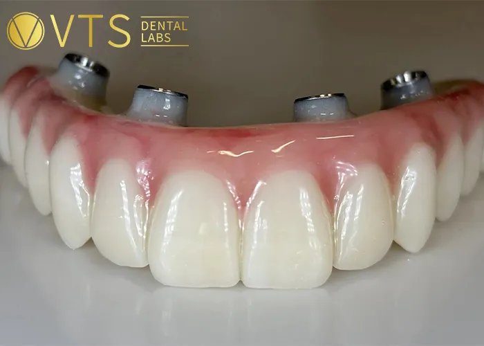 All-On-4-Dental-Implant-All-the-Essential-information-You-need