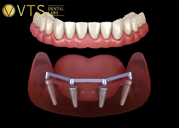 All-On-4-Dental-Implant-All-the-Essential-information-You-need