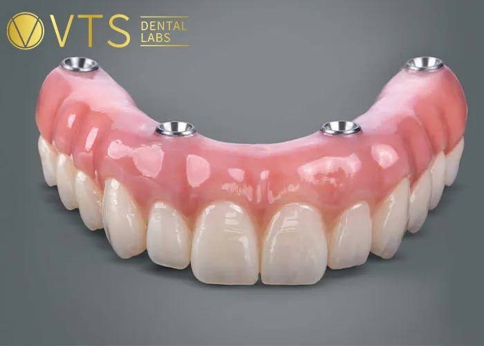 All-On-4-Dental-Implant-All-the-Essential-information-You-need