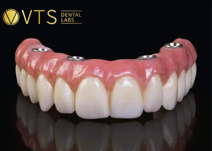 All-On-4-Dental-Implant-All-the-Essential-information-You-need