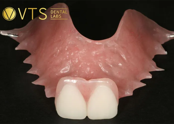 Discover-the-Power-of-Single-Tooth-Dentures-Key-Benefits -and-Lab-Selection-Guide