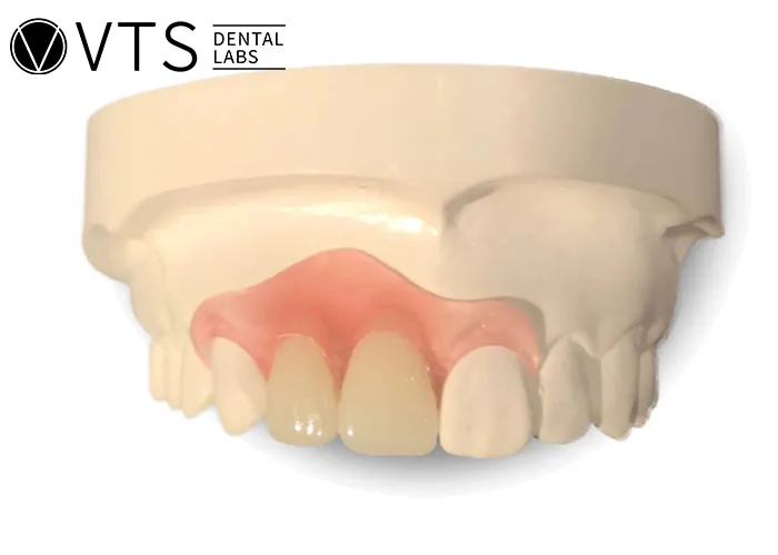 Discover-the-Power-of-Single-Tooth-Dentures-Key-Benefits -and-Lab-Selection-Guide